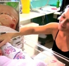 Sydney’s “miracle” conjoined twins Faith and Hope conceived with extraordinary condition “disrosopus”